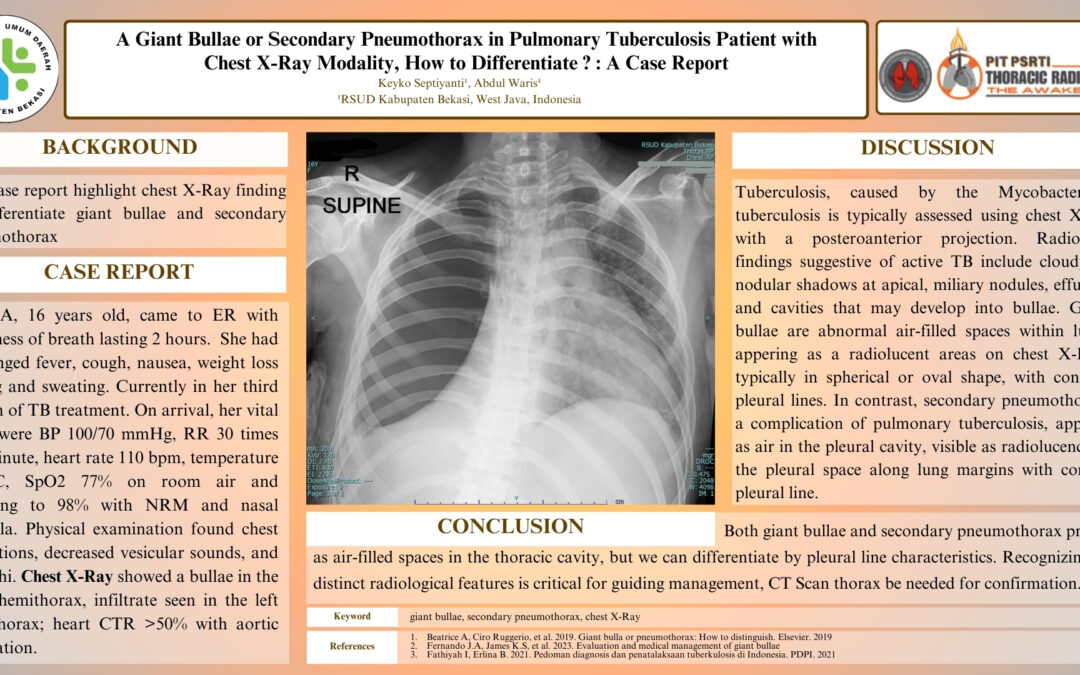 A Giant Bullae or Secondary Pneumothorax in Pulmonary Tuberculosis Patient with Chest X-Ray Modality, How to Differentiate? : A Case Report