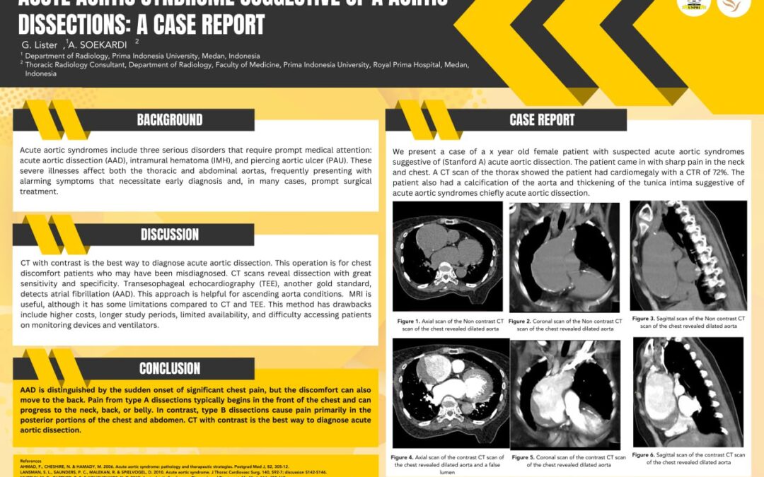 Acute Aortic Syndrome Suggestive of A Aortic Dissections: A Case Report