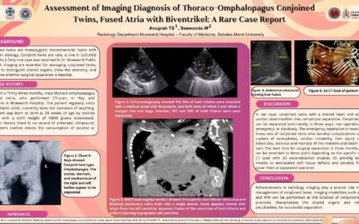 Assessment of Imaging Diagnosis of Thoraco-Omphalopagus Conjoined Twins, Fused Atria with Biventrikel: A Rare Case Report