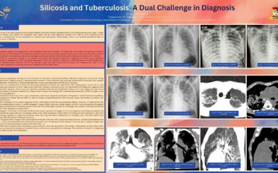 Silicosis and Tuberculosis: A Dual Challenge in Diagnosis