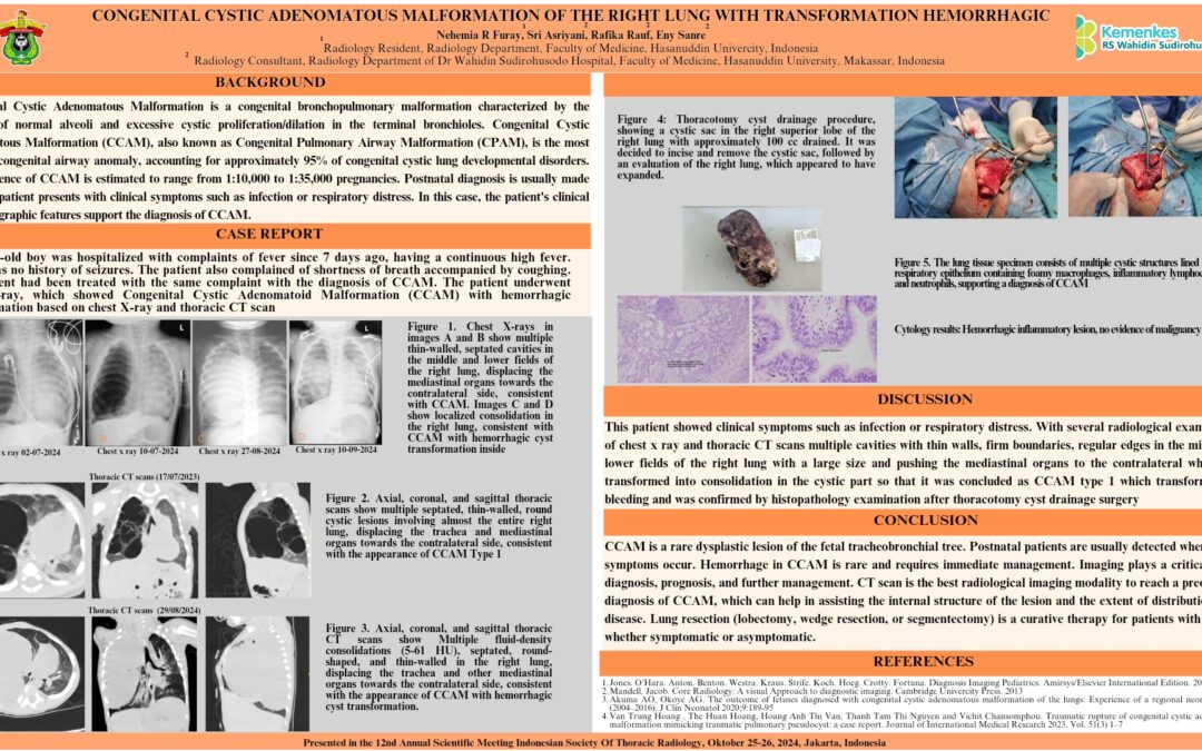 Congenital Cystic Adenomatous Malformation of The Right Lung with Hemorrhagic Transformation