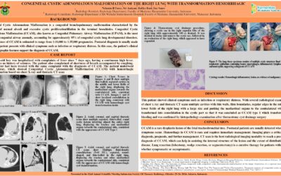 Congenital Cystic Adenomatous Malformation of The Right Lung with Hemorrhagic Transformation