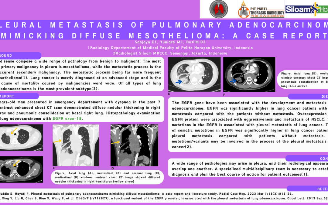 Pleural Metastasis of Pulmonary Adenocarcinoma Mimicking Diffuse Mesothelioma: A Case Report