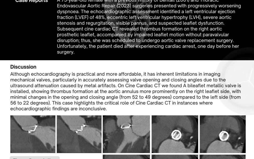 Cine Cardiac Computed Tomography As A Comprehensive Combination of Imaging Modalities to Evaluate Prosthetic Mechanic Heart Valve: A Case Report